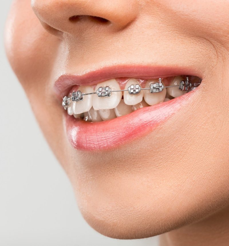 braces1 braces1