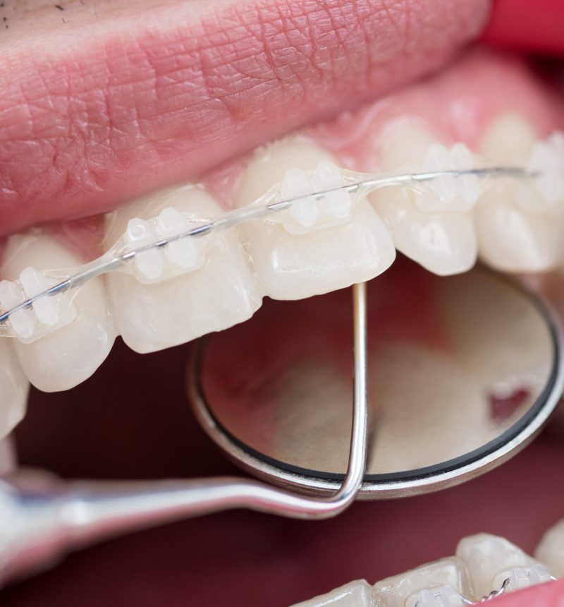 Dentist checking up teeth with ceramic brackets using dental tools – probe and mirror Dentist checking up teeth with ceramic brackets using dental tools - probe and mirror at the dental office. Macro shot of teeth with braces. Orthodontic Treatment. Dentistry