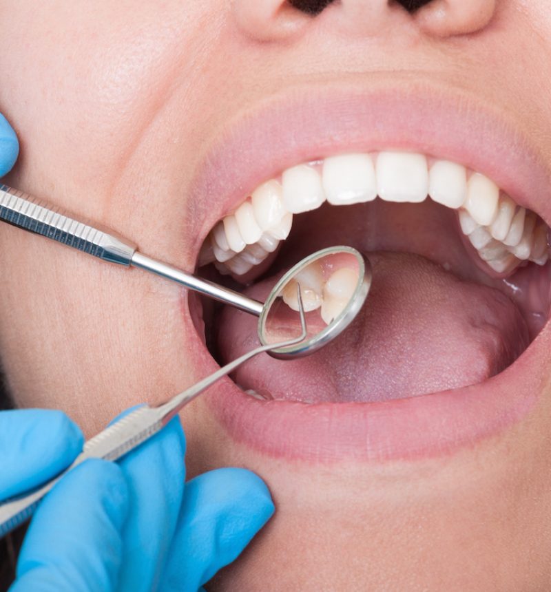 Dentist tools and mouth open with beautiful teeth Closeup of dentist tools and mouth open with beautiful teeth