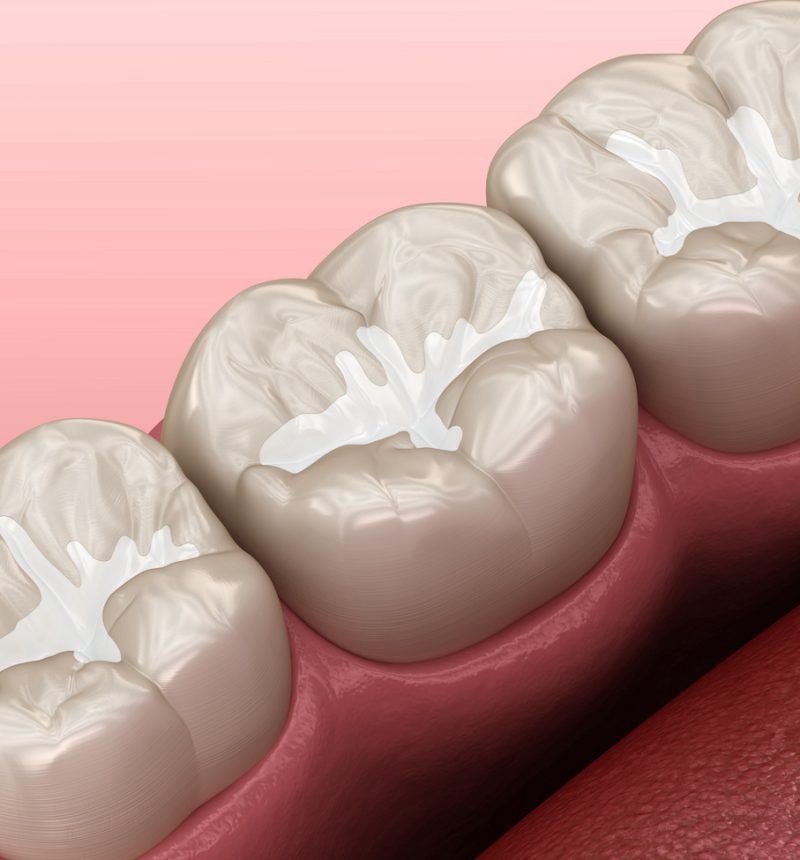 Molar Fissure dental fillings, Medically accurate 3D illustration of dental concept Molar Fissure dental fillings, Medically accurate 3D illustration of dental concept